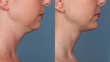 Double chin relief with Kybella