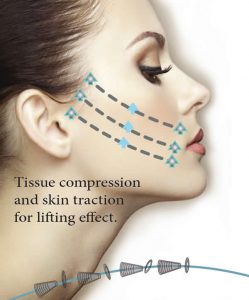 Non-invasive face lift Silhouette InstaLift