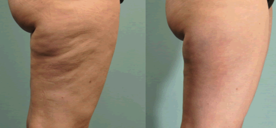 what is 40 units of semaglutide in mg Maximum Semaglutide Dosing: Exploring Benefits and Risks