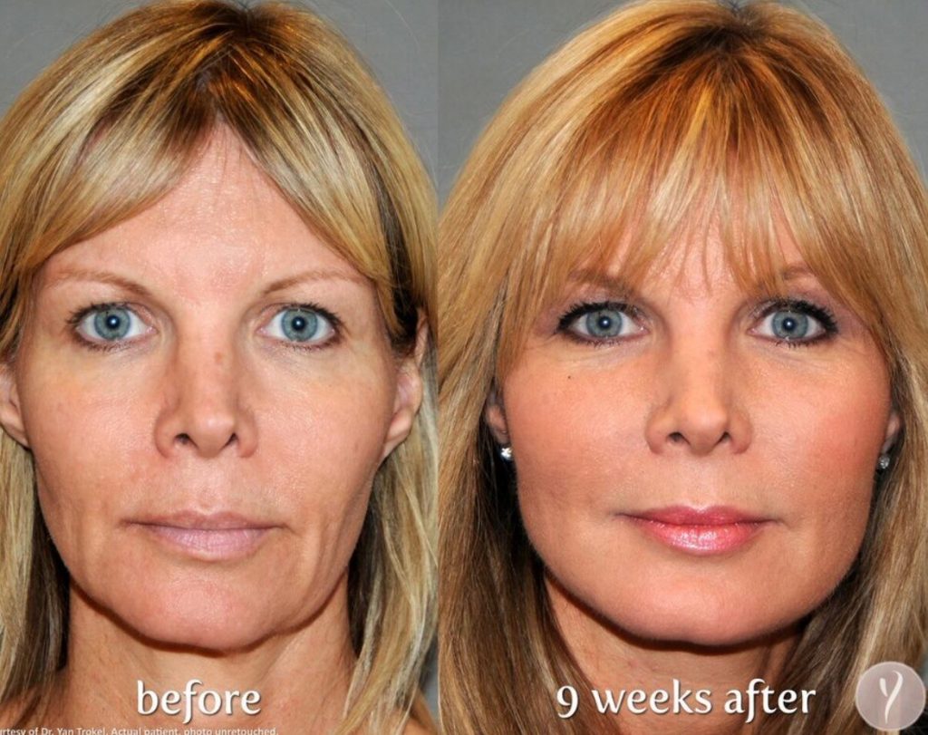 YLIFT bye to sagging skin