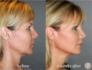 Facial Contouring Y LIFT: tighten skin without surgery