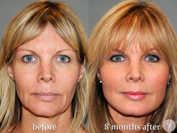 Facial Contouring with the YLIFT