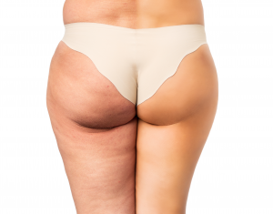 Treatment for cellulite that works: cellulite facts