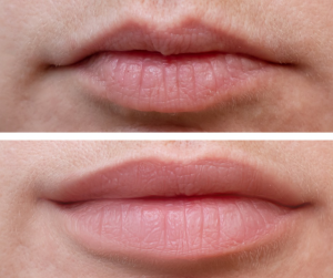 Lips Fillers Before and After