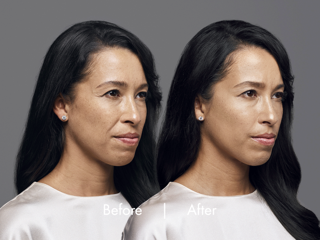 A dermal filler that gives you a more natural look