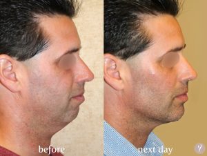 This facial rejuvenation technique takes approximately one hour