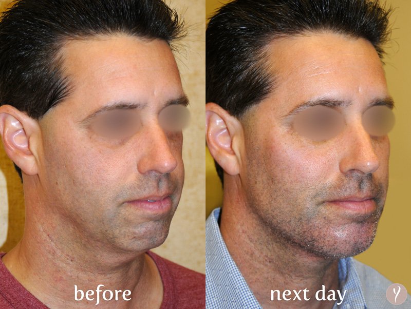 Facial Rejuvenation: The Dr. Nangrani LIFT