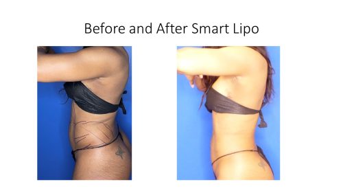 Female client with a contoured stomach