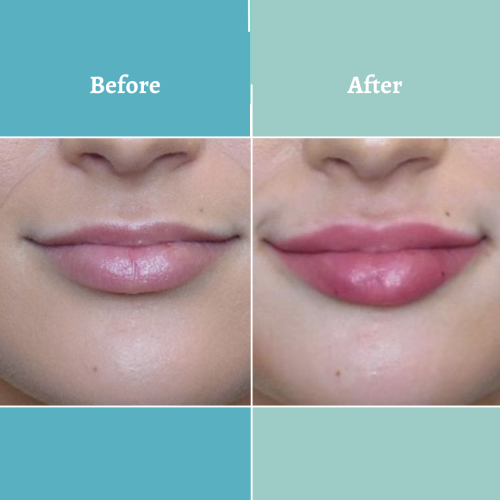 Lip Filler By Dr. Nangrani at Vedas Medical Spa & Wellness Center
