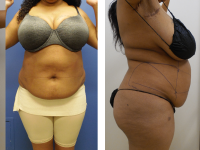 BEFORE SL (01/28/19) AND AFTER (02/14/19) SmartLipo