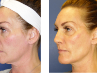 Before and after fillers and Y-LIFT Y-LIFT and fillers