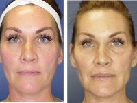 Before fillers 10-22-19 and after 10-23-19, Y-LIFT Before fillers 10-22-19 and after 10-23-19