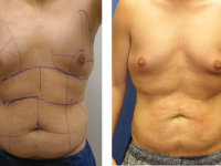 SmartLipo - Abs
