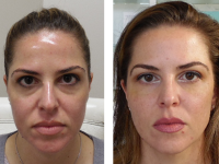 Before fillers 10/19/18 and after 10/26/18 Voluma Before and After