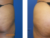 Fat Transfer