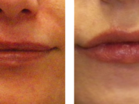 Juvederm gives dermal filler advantages over surgery Juvederm lip augmentation
