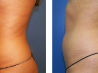 Smart Lipo - Abs