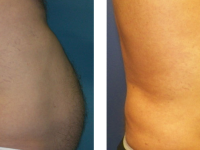 Smart Lipo - Abs