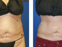 Smart Lipo - Abs