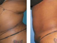 Smart Lipo - Abs
