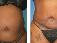 Smart Lipo - Abs