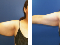 Smart Lipo - Arms