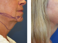 Smart Lipo - Chin
