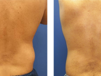 Smart Lipo - handles