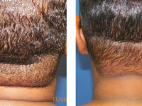 Smart Lipo - neck