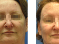 SmartSkin CO2 Fraxel
