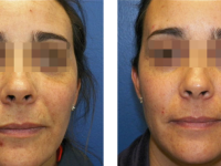 SmartSkin CO2 Fraxel